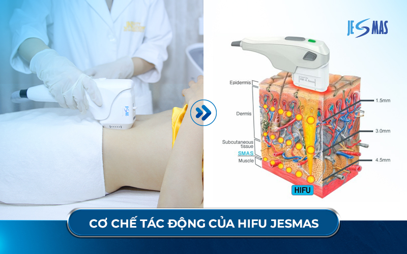 Cách chọn máy hifu phù hợp cho Spa