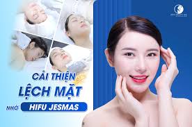 Công nghệ nâng cơ Hifu Jesmas là gì ?