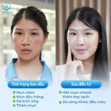 Bảng Giá Trị Mụn 2026 – Chi Phí Trị Mụn Bao Nhiêu?